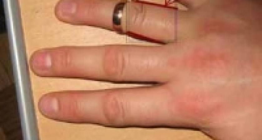 Палец посинел после полудня