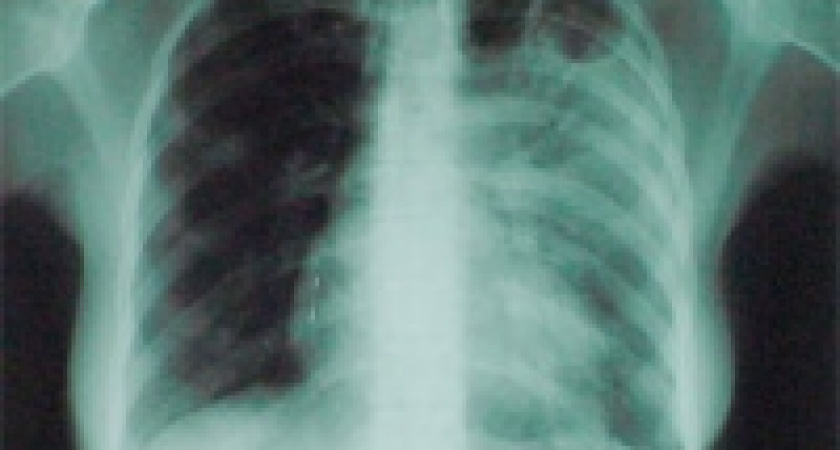Прокурор против флюорографии