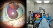 Липецкие врачи спасли зрение пациентке с выпавшим хрусталиком глаза